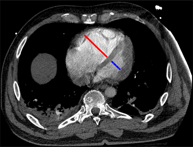 g : Examples of study- and image-level labels. (a) Central Pulmonary Embolism (PE): saddle embolus within the main, righ
