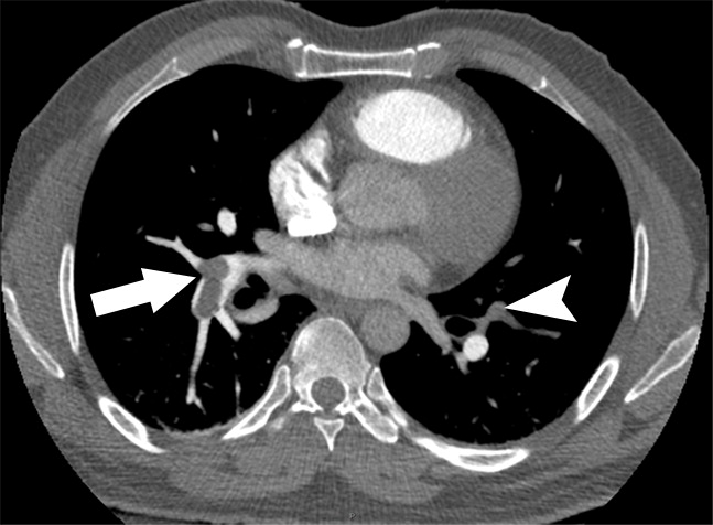 b : Examples of study- and image-level labels. (a) Central Pulmonary Embolism (PE): saddle embolus within the main, righ