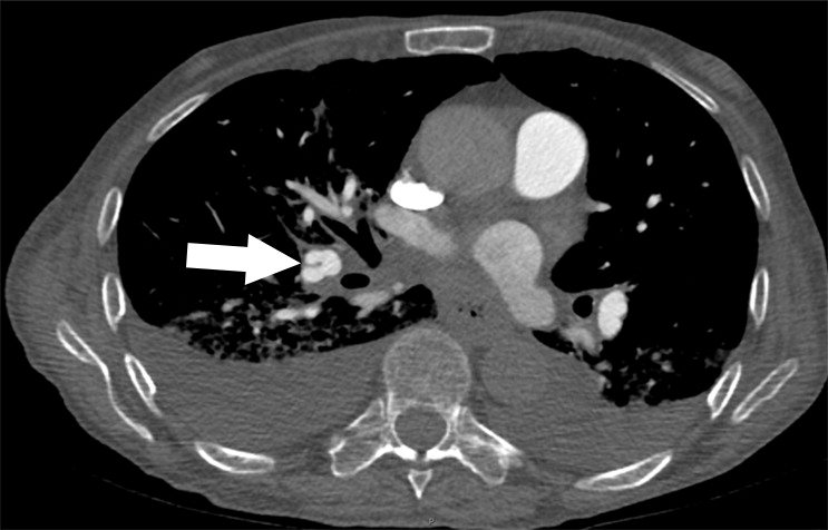 c : Examples of study- and image-level labels. (a) Central Pulmonary Embolism (PE): saddle embolus within the main, righ