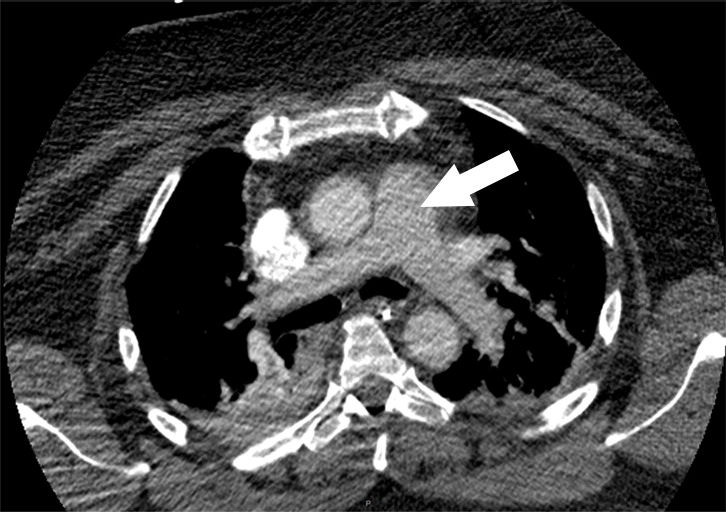 i : Examples of study- and image-level labels. (a) Central Pulmonary Embolism (PE): saddle embolus within the main, righ