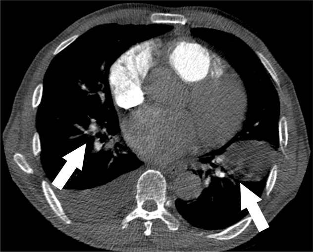 h : Examples of study- and image-level labels. (a) Central Pulmonary Embolism (PE): saddle embolus within the main, righ