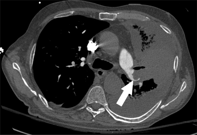d : Examples of study- and image-level labels. (a) Central Pulmonary Embolism (PE): saddle embolus within the main, righ