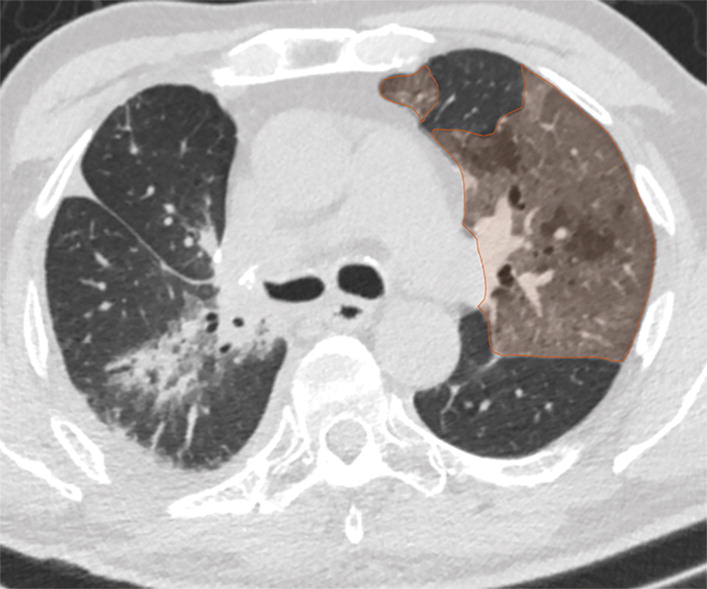 a : Examples of image-level annotations on axial CT images indicated with orange regions of interest. (a) Infectious opa