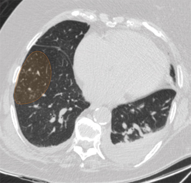 b : Examples of image-level annotations on axial CT images indicated with orange regions of interest. (a) Infectious opa