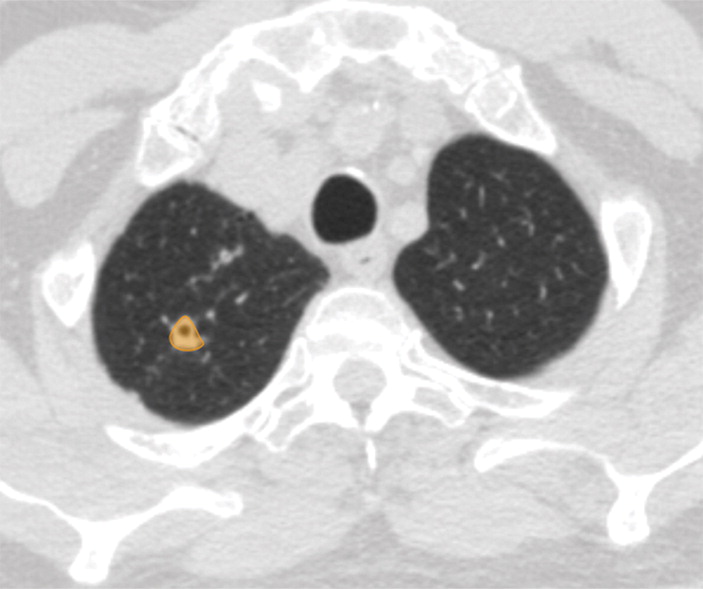 c : Examples of image-level annotations on axial CT images indicated with orange regions of interest. (a) Infectious opa