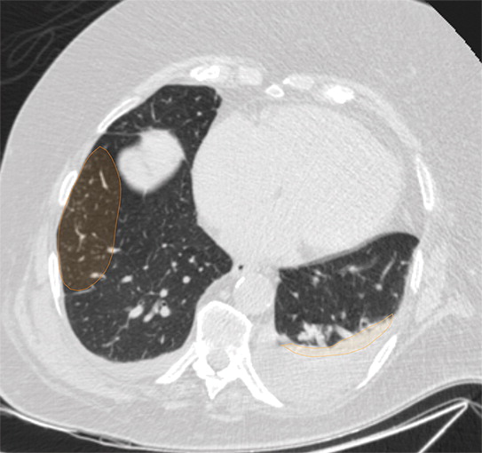 c : Example of CT scans and chest radiographs in the RSNA International COVID-19 Open Radiology Database. (a) Annotated