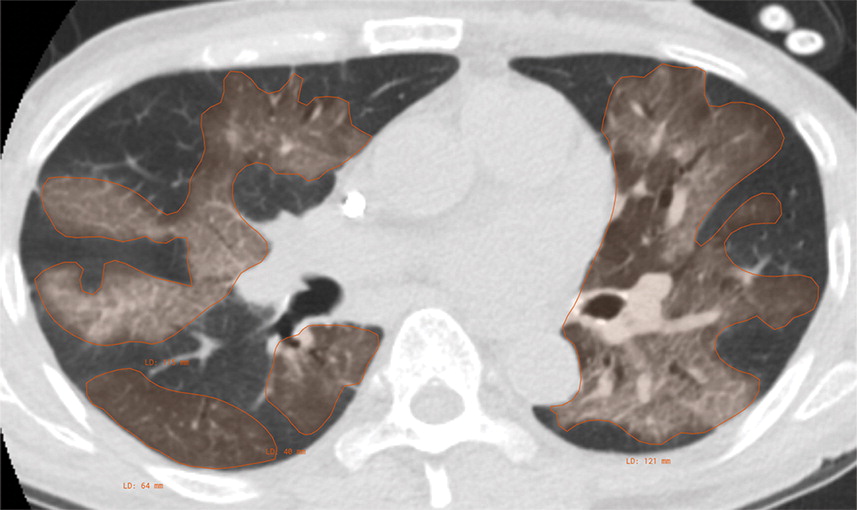 b : Example of CT scans and chest radiographs in the RSNA International COVID-19 Open Radiology Database. (a) Annotated