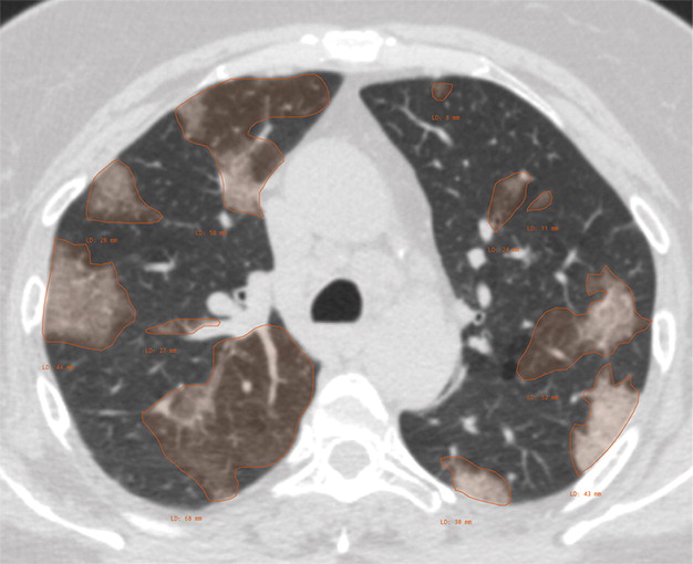 a : Example of CT scans and chest radiographs in the RSNA International COVID-19 Open Radiology Database. (a) Annotated