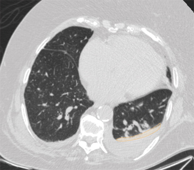 e : Examples of image-level annotations on axial CT images indicated with orange regions of interest. (a) Infectious opa