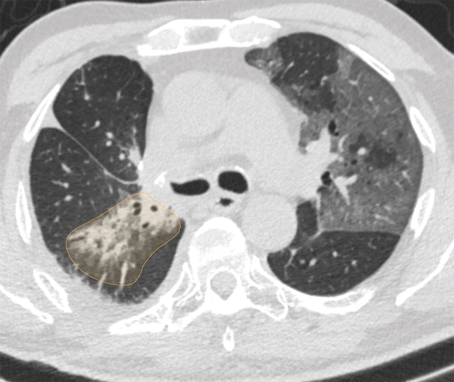 f : Examples of image-level annotations on axial CT images indicated with orange regions of interest. (a) Infectious opa