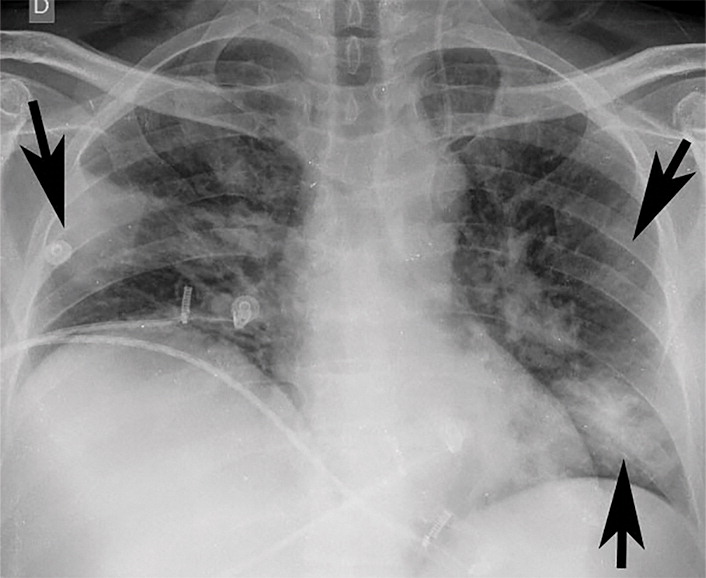 e : Example of CT scans and chest radiographs in the RSNA International COVID-19 Open Radiology Database. (a) Annotated