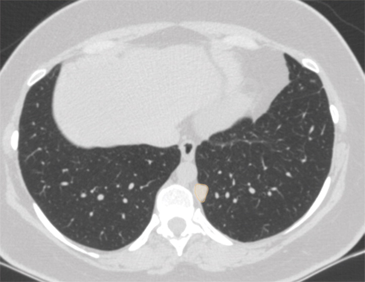 d : Examples of image-level annotations on axial CT images indicated with orange regions of interest. (a) Infectious opa