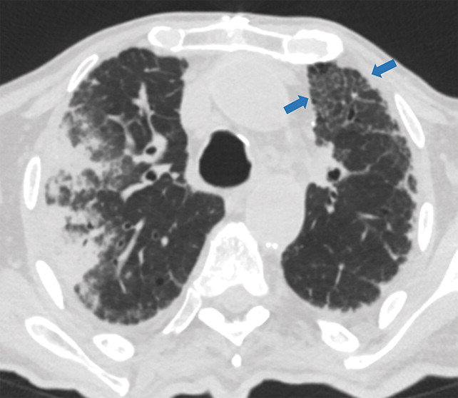 c : Examples of examination-level annotations on axial CT images. (a) Ground-glass opacities surrounding a nodular opaci