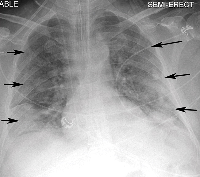 f : Example of CT scans and chest radiographs in the RSNA International COVID-19 Open Radiology Database. (a) Annotated