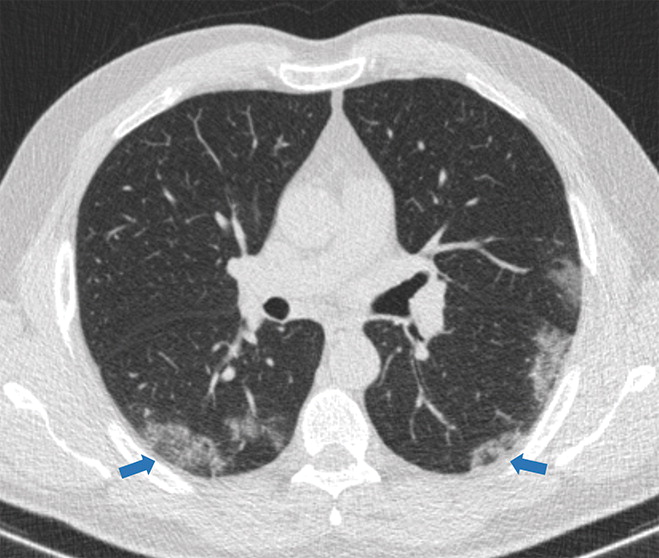 b : Examples of examination-level annotations on axial CT images. (a) Ground-glass opacities surrounding a nodular opaci