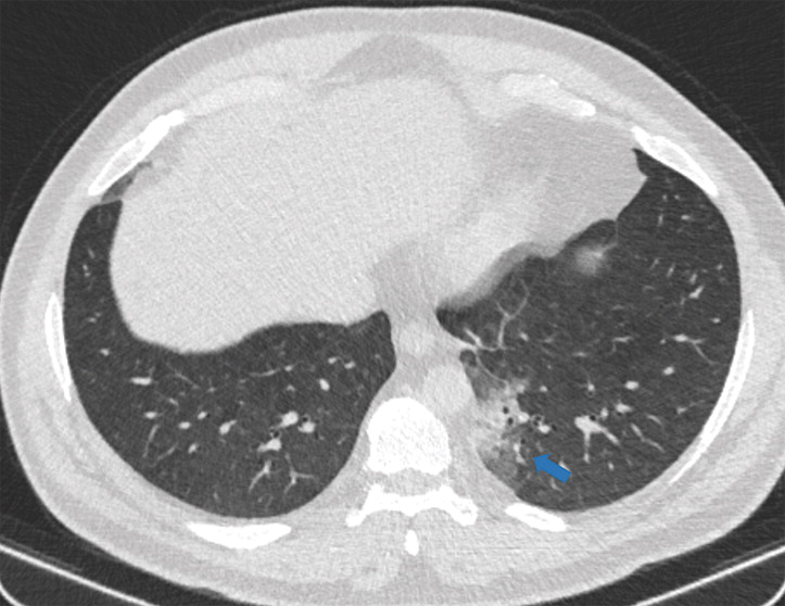a : Examples of examination-level annotations on axial CT images. (a) Ground-glass opacities surrounding a nodular opaci