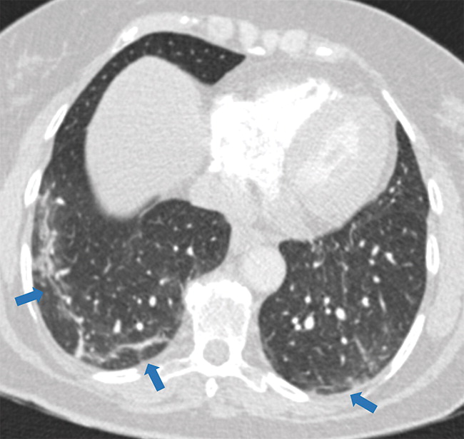 g : Examples of examination-level annotations on axial CT images. (a) Ground-glass opacities surrounding a nodular opaci