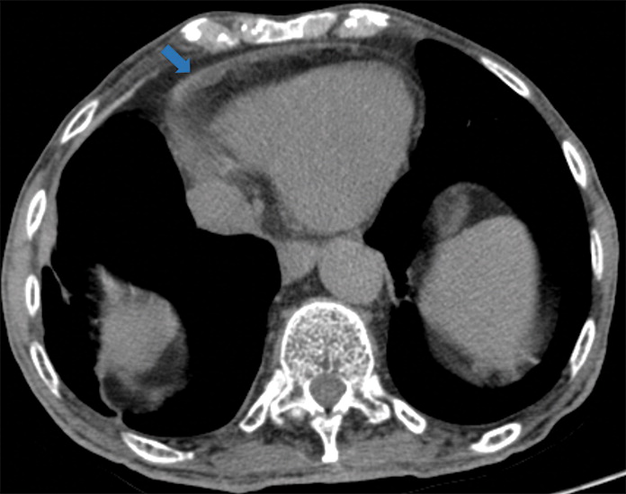 k : Examples of examination-level annotations on axial CT images. (a) Ground-glass opacities surrounding a nodular opaci