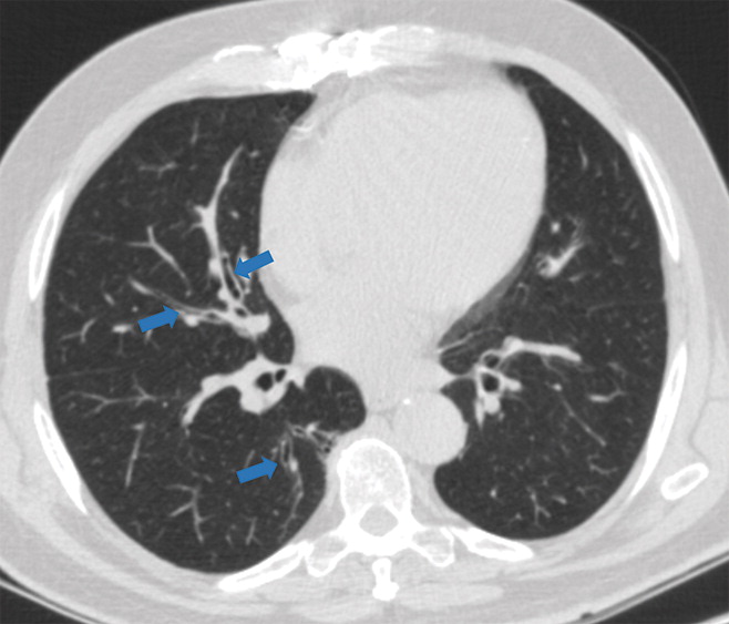 e : Examples of examination-level annotations on axial CT images. (a) Ground-glass opacities surrounding a nodular opaci
