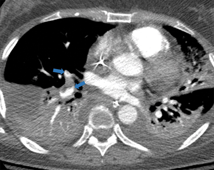 m : Examples of examination-level annotations on axial CT images. (a) Ground-glass opacities surrounding a nodular opaci