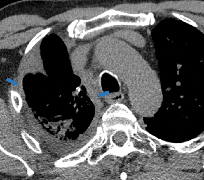 i : Examples of examination-level annotations on axial CT images. (a) Ground-glass opacities surrounding a nodular opaci