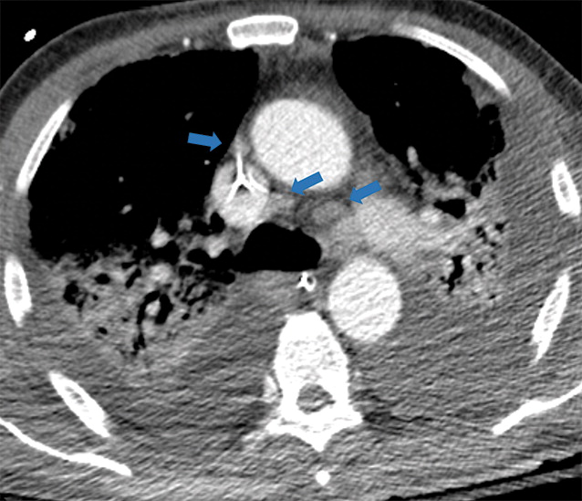l : Examples of examination-level annotations on axial CT images. (a) Ground-glass opacities surrounding a nodular opaci