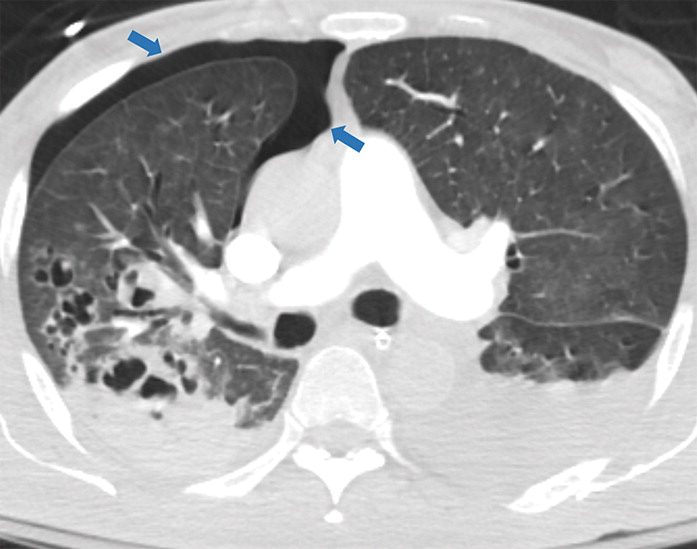 j : Examples of examination-level annotations on axial CT images. (a) Ground-glass opacities surrounding a nodular opaci