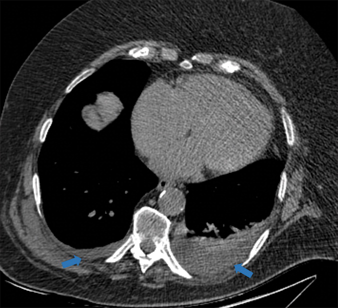 h : Examples of examination-level annotations on axial CT images. (a) Ground-glass opacities surrounding a nodular opaci