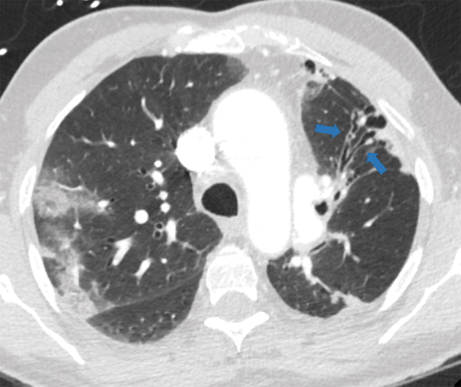 f : Examples of examination-level annotations on axial CT images. (a) Ground-glass opacities surrounding a nodular opaci
