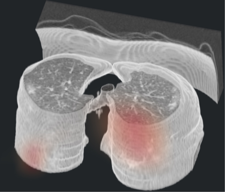 3D view of a model-generated 3D Grad-CAM superimposed on the CT of a COVID+ case with bilateral peripheral ground glass