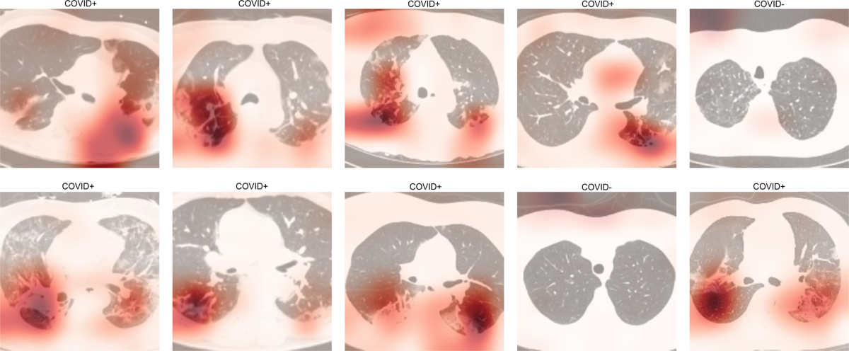 Grad-CAM over CT scans of COVID19+ and COVID19- pneumonia patients.