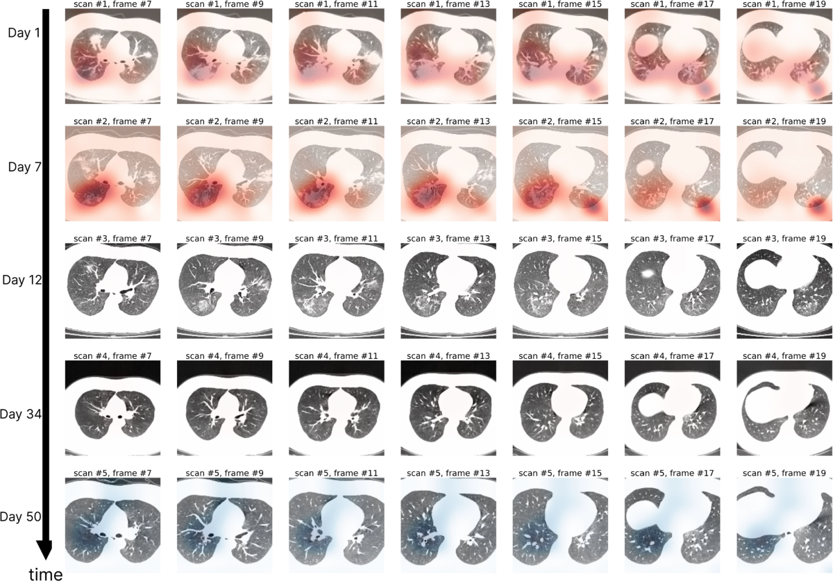 Case study using DCD on a follow-up patient (24 years old) with 5 scans.