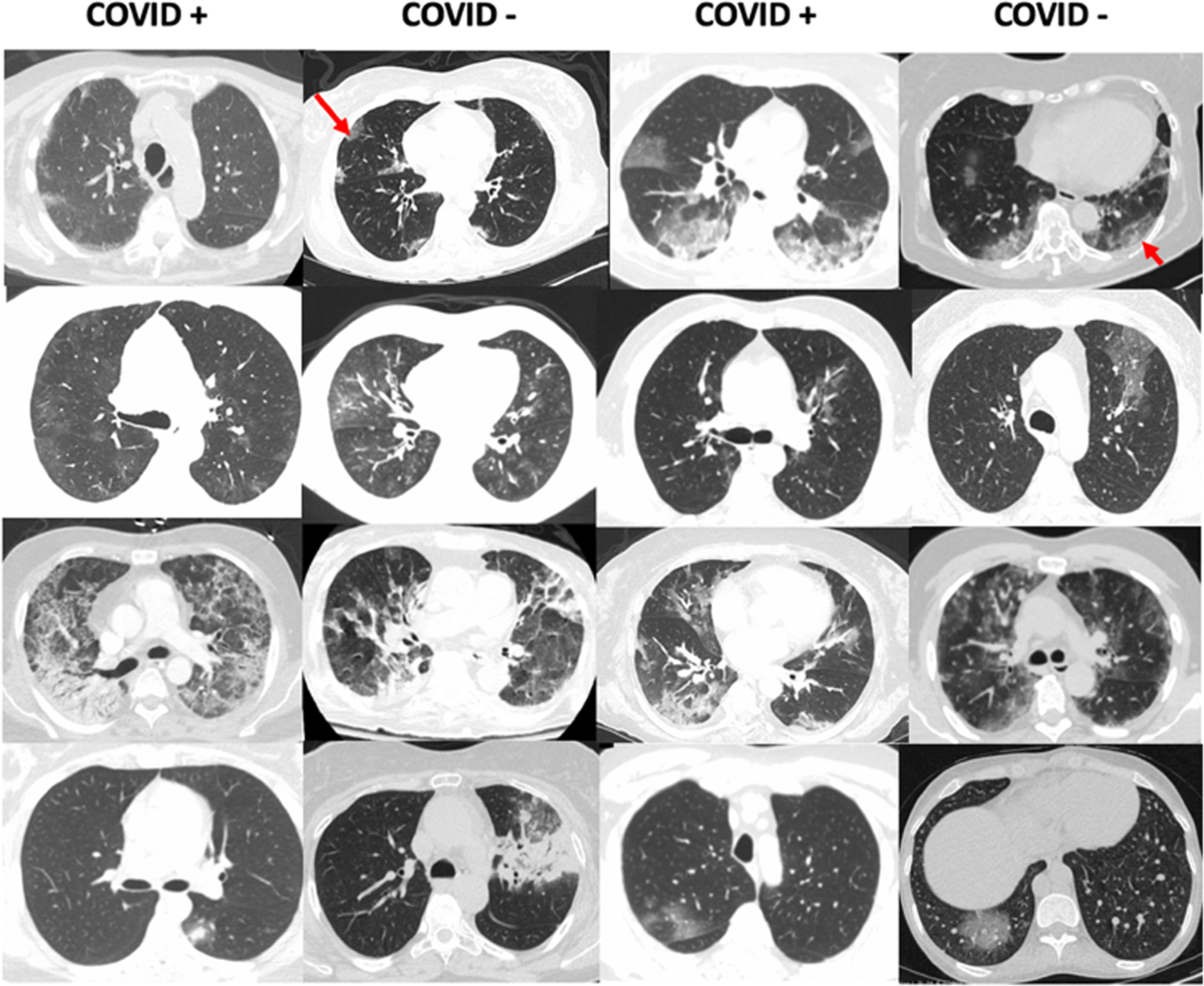 Examples of COVID− PNA patients in our study that show heterogeneous features, some that are similar to COVID+ PNA.