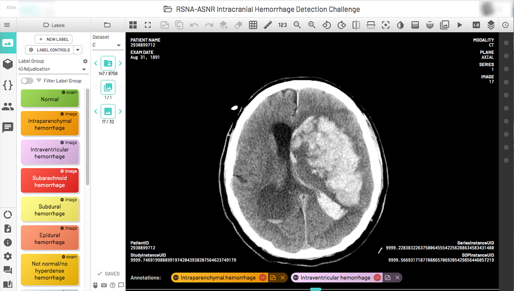 A complex multicompartmental cerebral hemorrhage on a single axial CT image displayed using the annotation tool in a sin