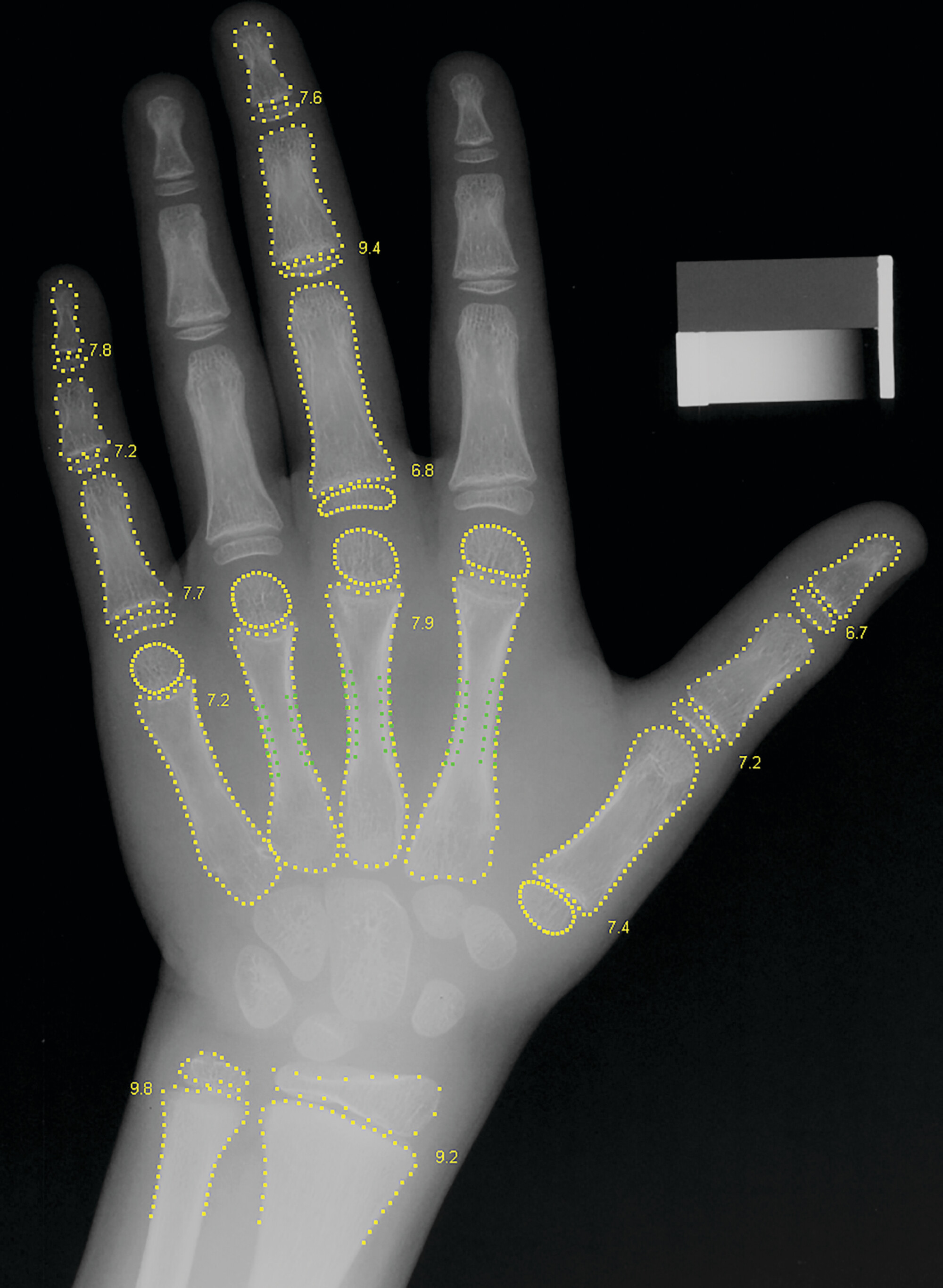 Radiograph of a boy’s left hand shows the preprocessing method used by the fourth-place participant. A bone age value is