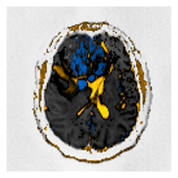 (c) From (a) to (c): (a) high “ b ”-value diffusion ( b 1000). (b) Corresponding ADC map, calculated with b 0, b 500, an