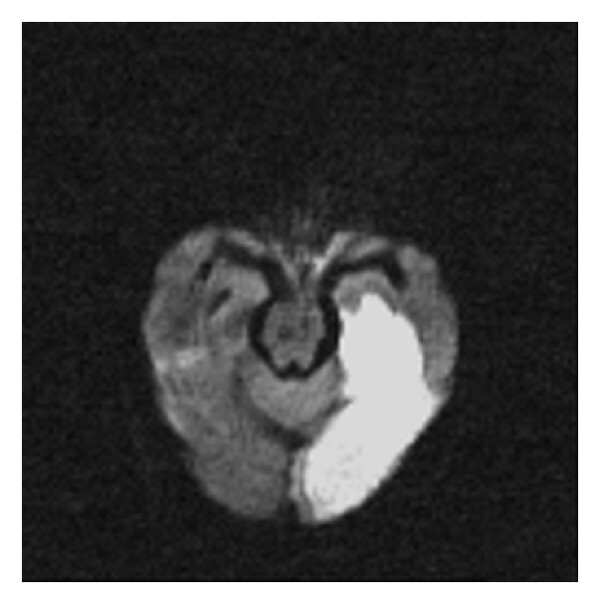 (a) (a) High “ b ”-value diffusion ( b 1000). (b) Corresponding ADC map. (c) Postprocessed image. This is an acute left 