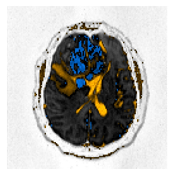 (f) From (a) to (c): (a) high “ b ”-value diffusion ( b 1000). (b) Corresponding ADC map, calculated with b 0, b 500, an