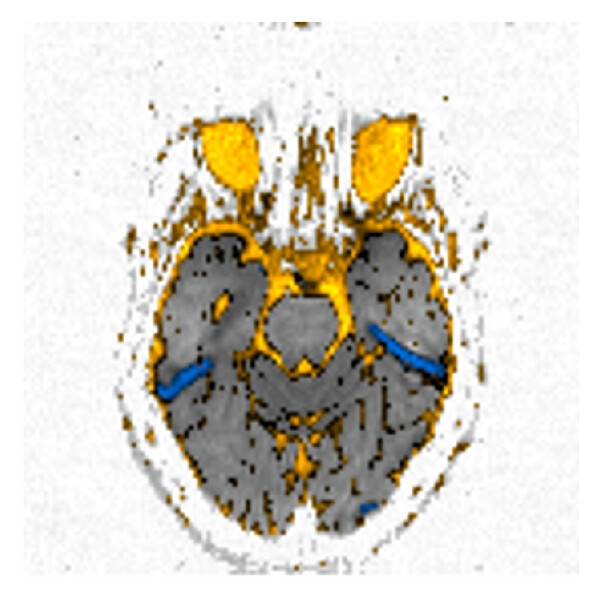 (c) (a) High “ b ”-value diffusion ( b 1000). (b) Corresponding ADC map. (c) Postprocessed image. This is an example of 