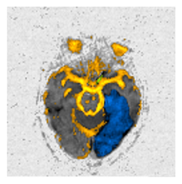 (c) (a) High “ b ”-value diffusion ( b 1000). (b) Corresponding ADC map. (c) Postprocessed image. This is an acute left 