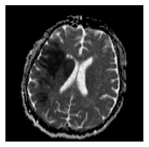 (b) (a) High “ b ”-value diffusion ( b 1000). (b) Corresponding ADC map. (c) Postprocessed image. This is an acute right