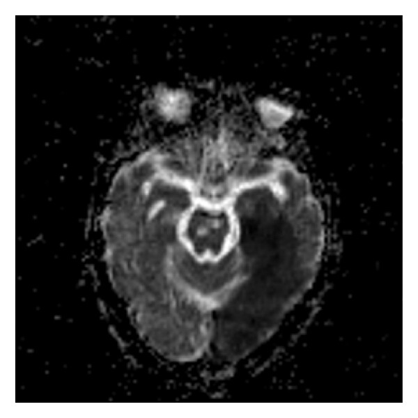 (b) (a) High “ b ”-value diffusion ( b 1000). (b) Corresponding ADC map. (c) Postprocessed image. This is an acute left 