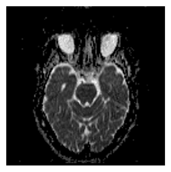 (b) (a) High “ b ”-value diffusion ( b 1000). (b) Corresponding ADC map. (c) Postprocessed image. This is an example of 