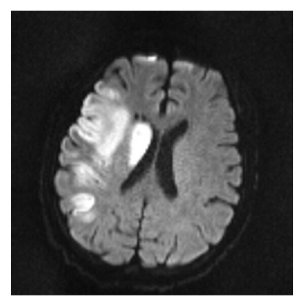(a) (a) High “ b ”-value diffusion ( b 1000). (b) Corresponding ADC map. (c) Postprocessed image. This is an acute right