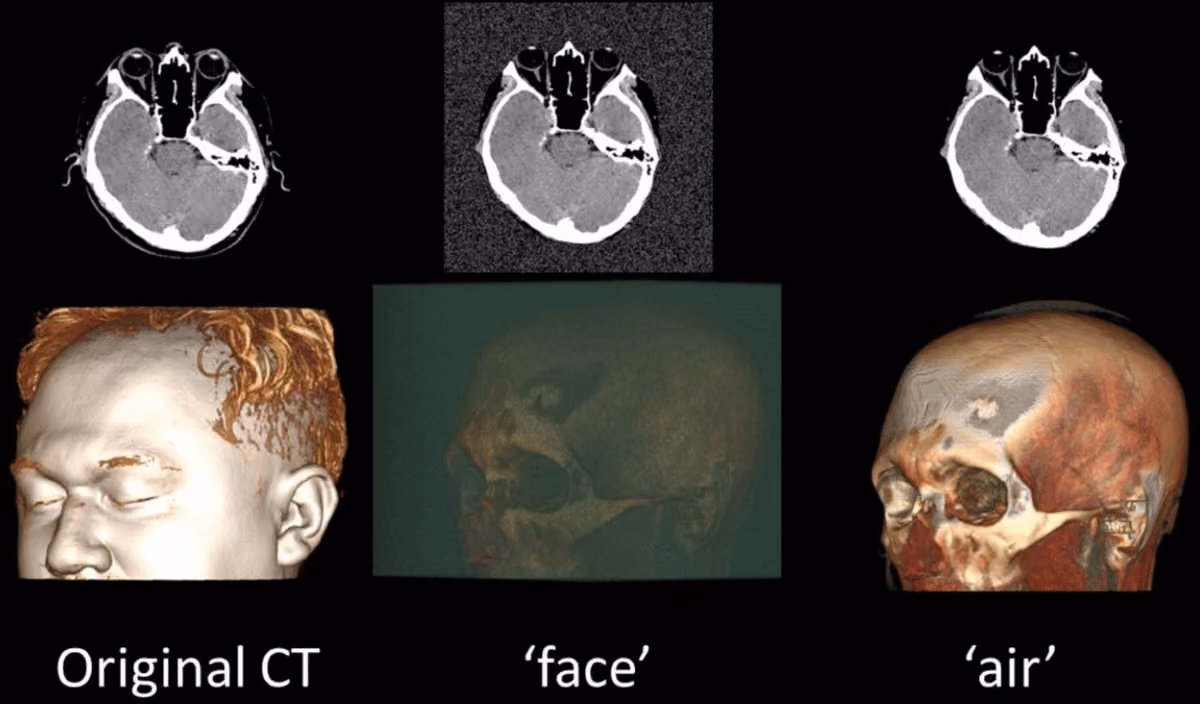 Pixel Tampering: Does Face Redaction Harm Medical AI