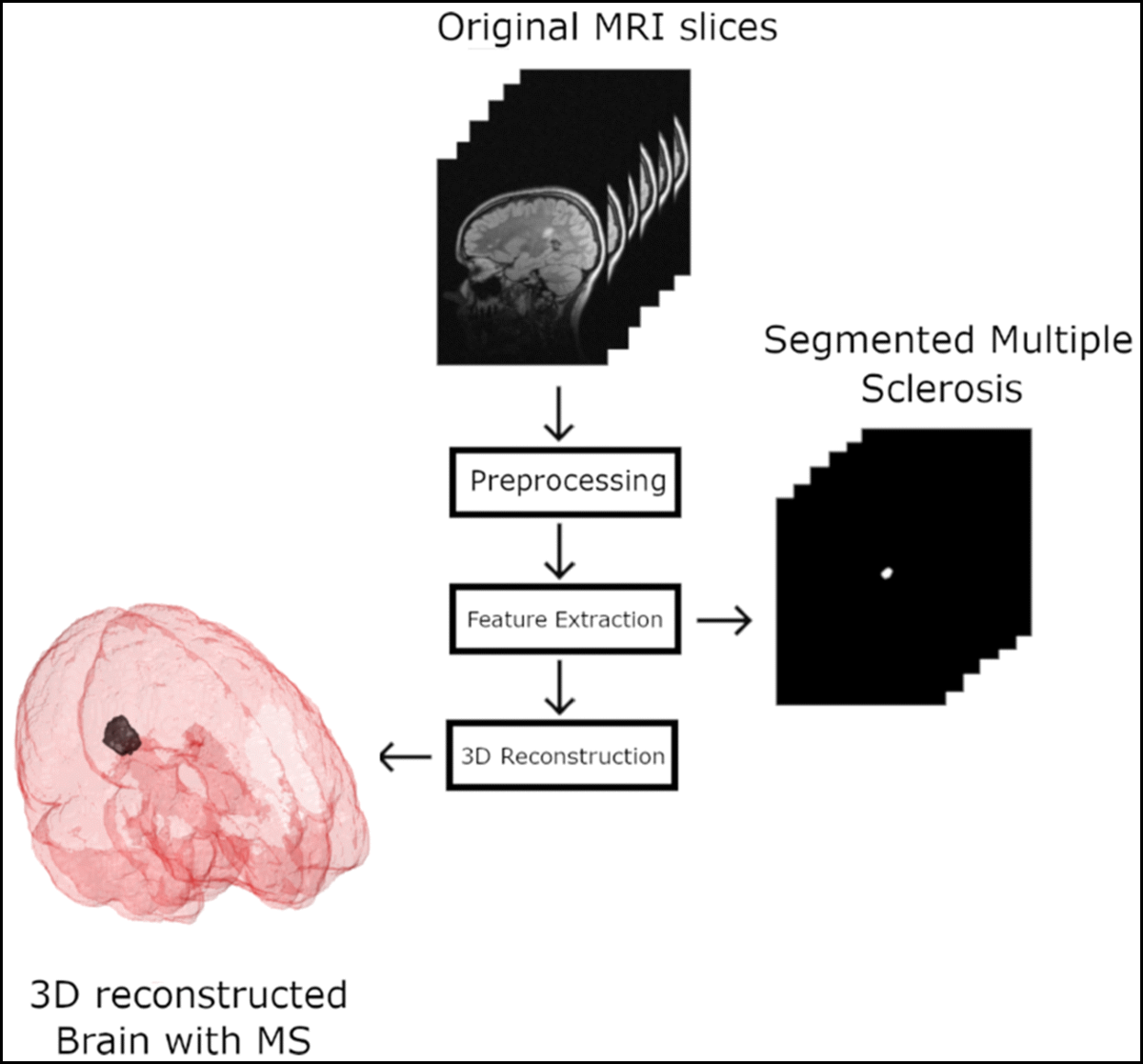 Multiple sclerosis segmentation method