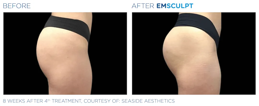 Emsculpt - Colorado Springs
