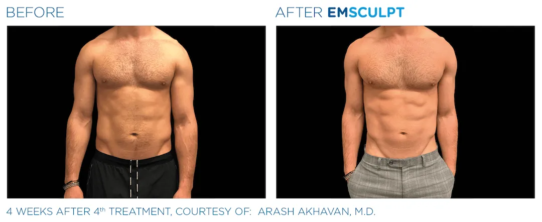 Emsculpt - Colorado Springs