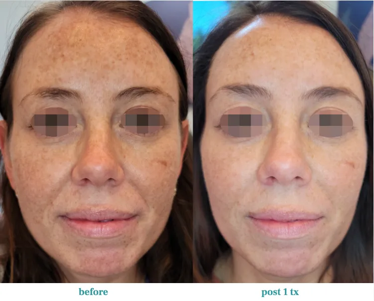 Renual Medspa opus before and after