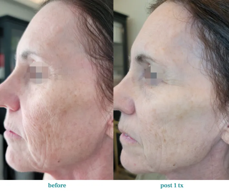 Renual Medspa opus before and after
